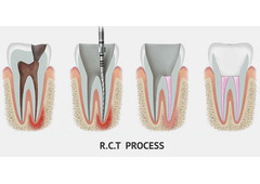 Save Your Tooth – Advanced Root Canal Treatment in Noida