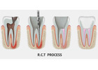 Save Your Tooth – Advanced Root Canal Treatment in Noida