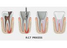 Save Your Tooth – Advanced Root Canal Treatment in Noida